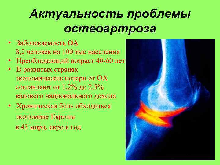 Актуальность проблемы остеоартроза • Заболеваемость ОА 8, 2 человек на 100 тыс населения •