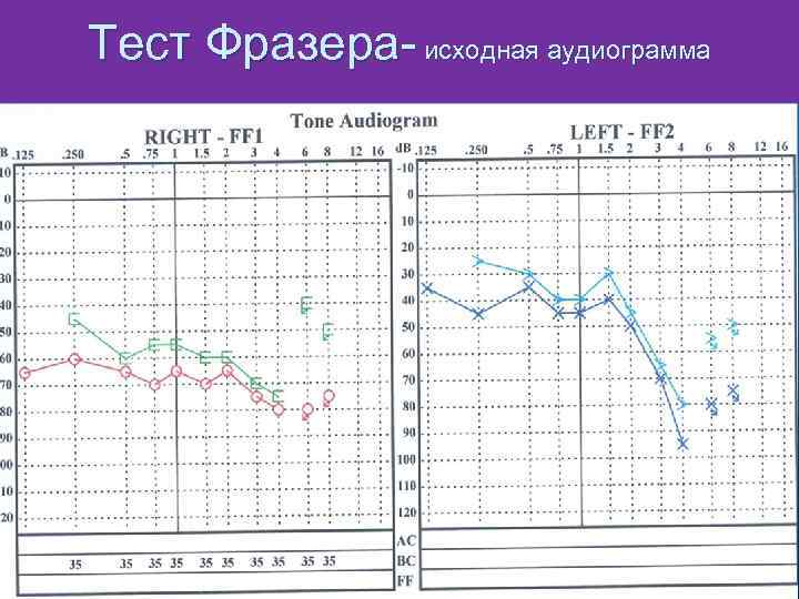 Тест Фразера- исходная аудиограмма n 