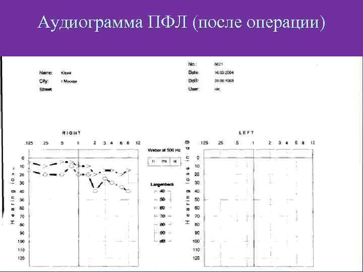 Аудиограмма ПФЛ (после операции) 