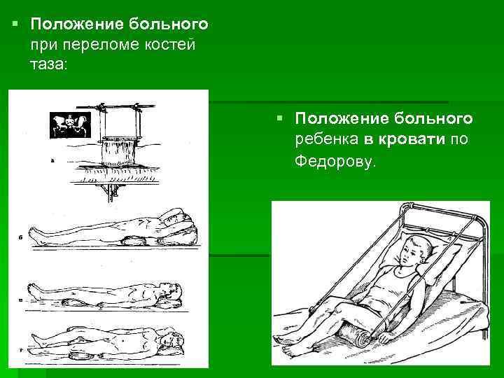 § Положение больного при переломе костей таза: § Положение больного ребенка в кровати по