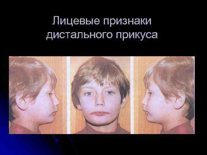 Лицевые признаки дистального прикуса 