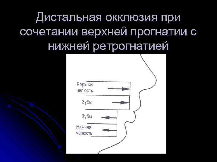 Дистальная окклюзия при сочетании верхней прогнатии с нижней ретрогнатией 