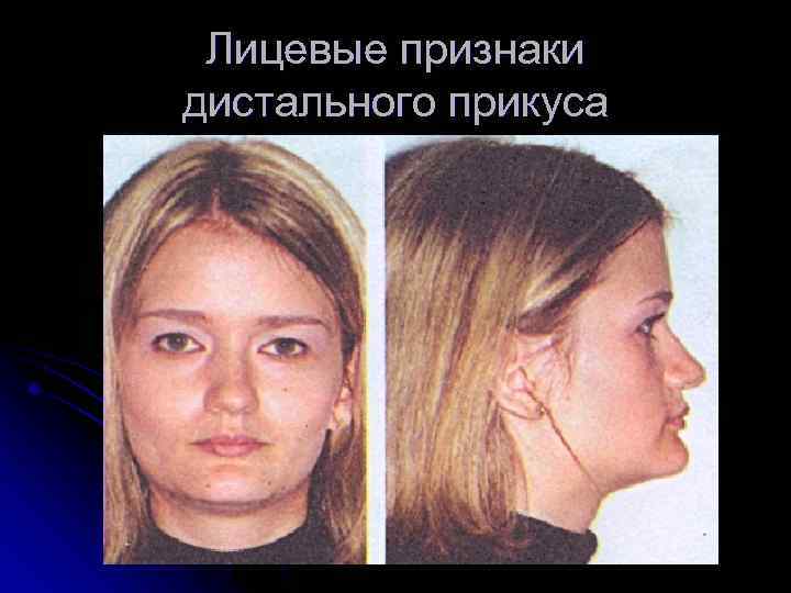 Лицевые признаки дистального прикуса 