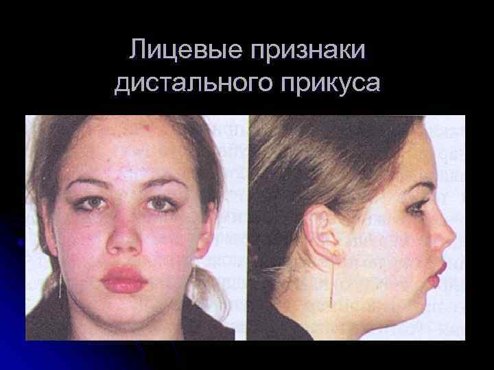 Лицевые признаки дистального прикуса 