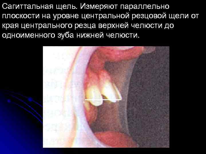 Сагиттальная щель. Измеряют параллельно плоскости на уровне центральной резцовой щели от края центрального резца