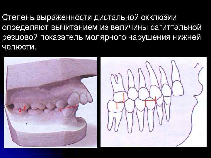 Степень выраженности дистальной окклюзии определяют вычитанием из величины сагиттальной резцовой показатель молярного нарушения нижней