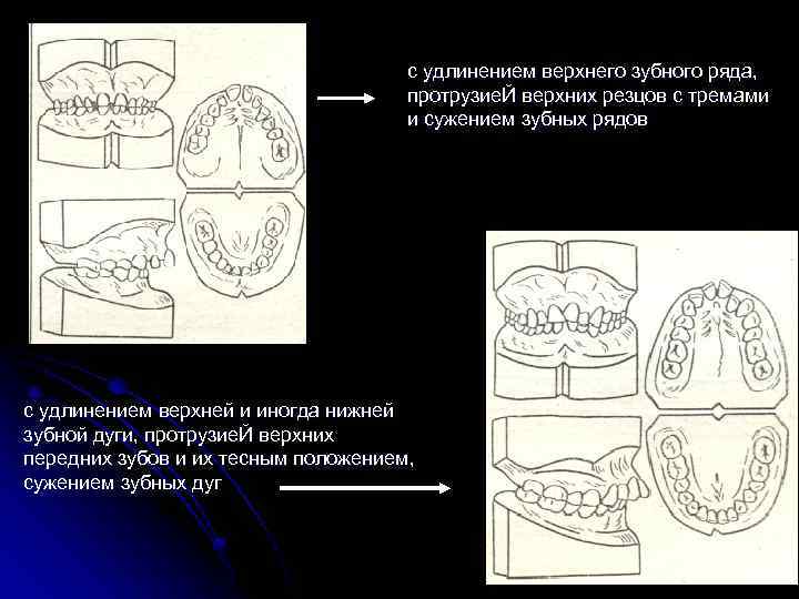 с удлинением верхнего зубного ряда, протрузие. Й верхних резцов с тремами и сужением зубных