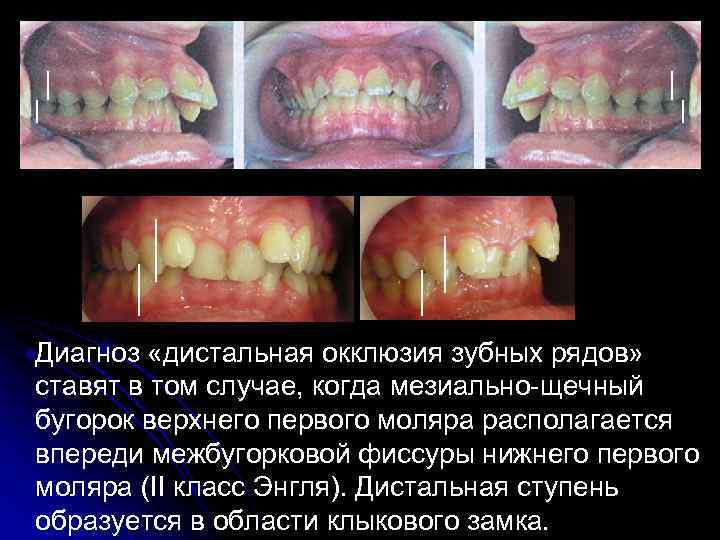 Диагноз «дистальная окклюзия зубных рядов» ставят в том случае, когда мезиально-щечный бугорок верхнего первого