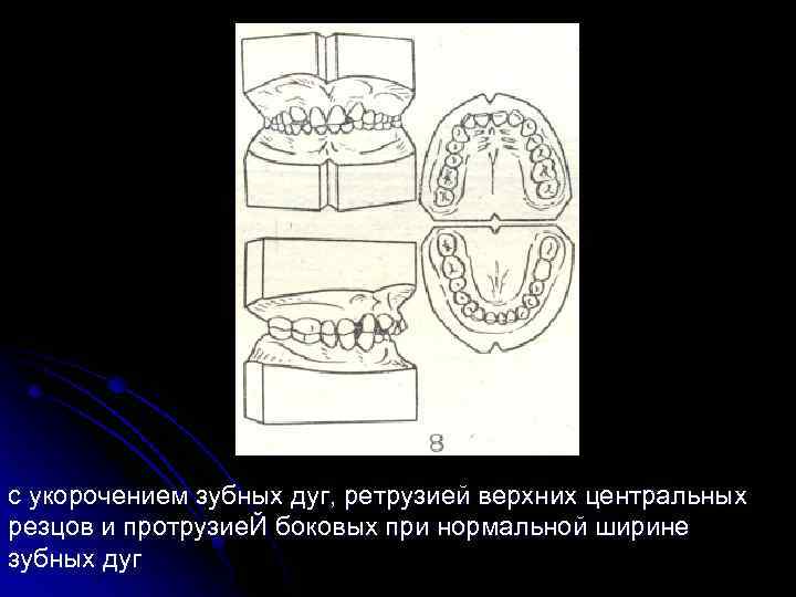 с укорочением зубных дуг, ретрузией верхних центральных резцов и протрузие. Й боковых при нормальной