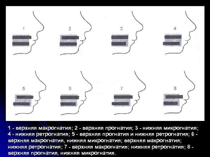 1 - верхняя макрогнатия; 2 - верхняя прогнатия; 3 - нижняя микрогнатия; 4 -