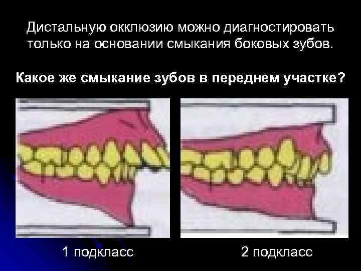 Дистальную окклюзию можно диагностировать только на основании смыкания боковых зубов. Какое же смыкание зубов