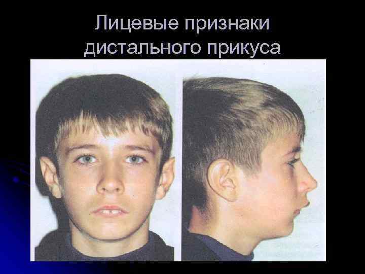 Лицевые признаки дистального прикуса 