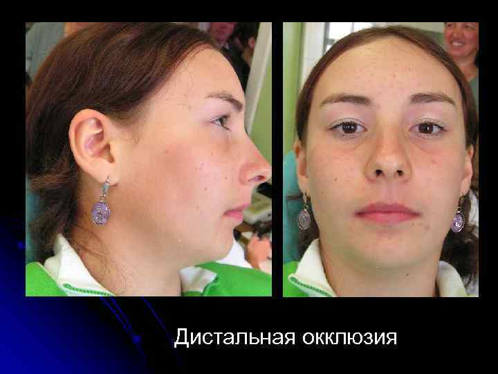 Дистальная окклюзия 