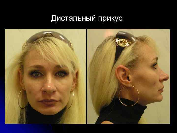 Дистальный прикус 