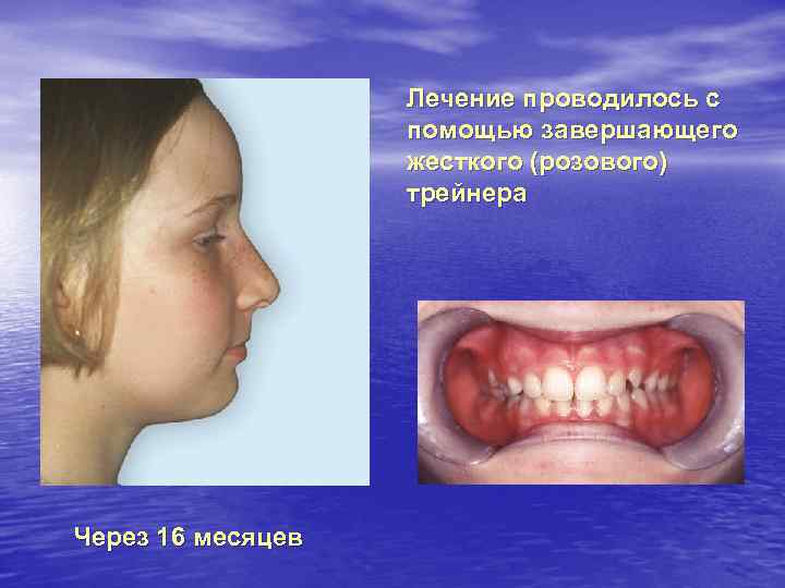 Лечение проводилось с помощью завершающего жесткого (розового) трейнера Через 16 месяцев 