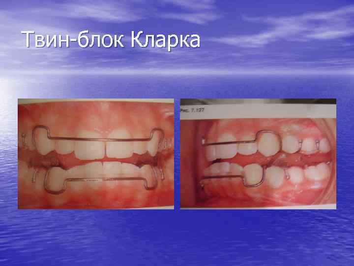 Твин-блок Кларка 