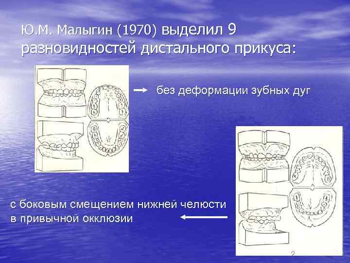 Ю. М. Малыгин (1970) выделил 9 разновидностей дистального прикуса: без деформации зубных дуг с