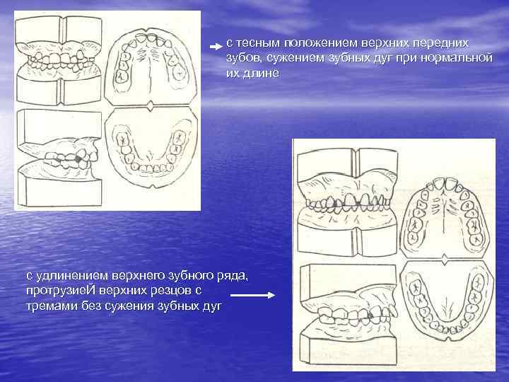 с тесным положением верхних передних зубов, сужением зубных дуг при нормальной их длине с