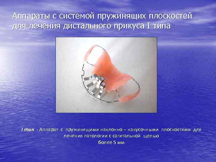 Аппараты с системой пружинящих плоскостей для лечения дистального прикуса I тип - Аппарат с