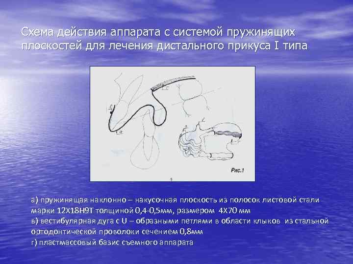 Действия аппарата. Аппараты для дистальной окклюзии. Аппараты для лечения дистального прикуса.