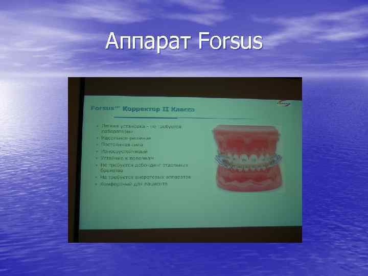 Аппарат Forsus 