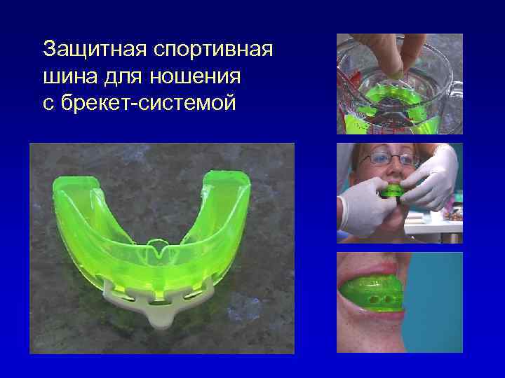 Защитная спортивная шина для ношения с брекет-системой 