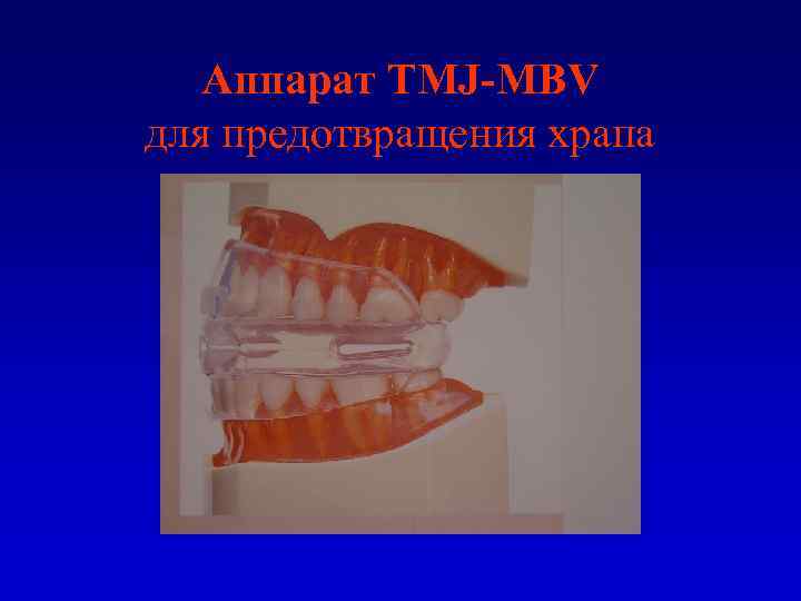 Аппарат TMJ-MBV для предотвращения храпа 