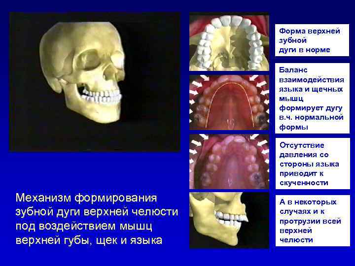 Форма верхней зубной дуги в норме Баланс взаимодействия языка и щечных мышц формирует дугу