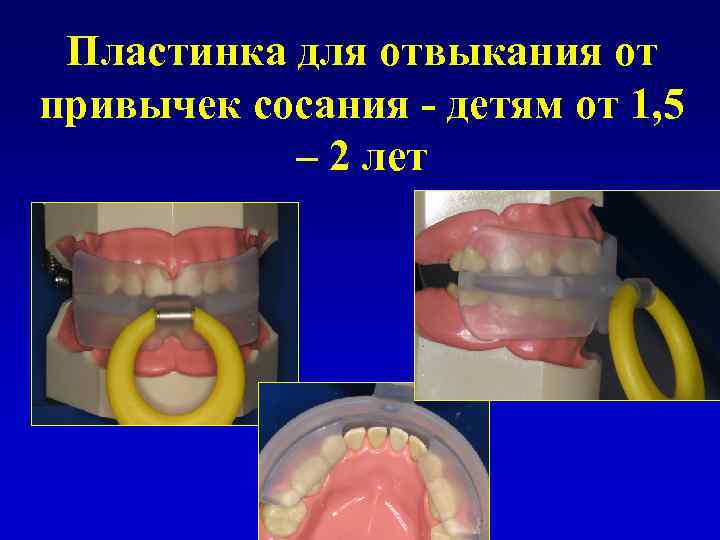 Пластинка для отвыкания от привычек сосания - детям от 1, 5 – 2 лет