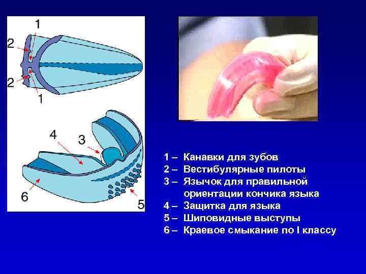 1 – Канавки для зубов 2 – Вестибулярные пилоты 3 – Язычок для правильной