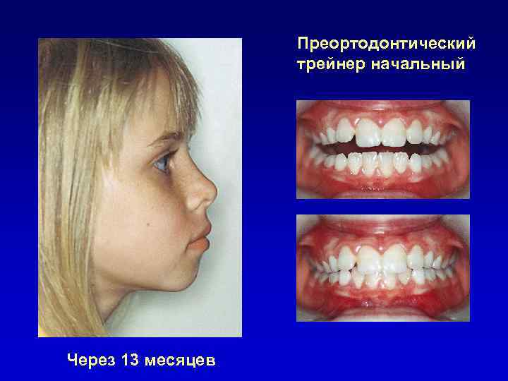 Преортодонтический трейнер начальный Через 13 месяцев 