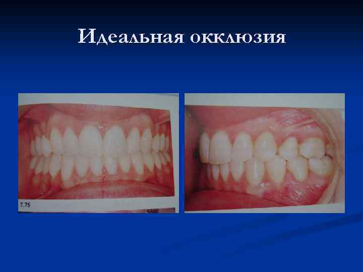 Идеальная окклюзия 