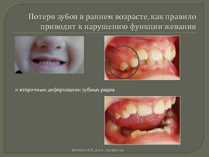 Потеря зубов в раннем возрасте, как правило приводит к нарушению функции жевания и вторичным