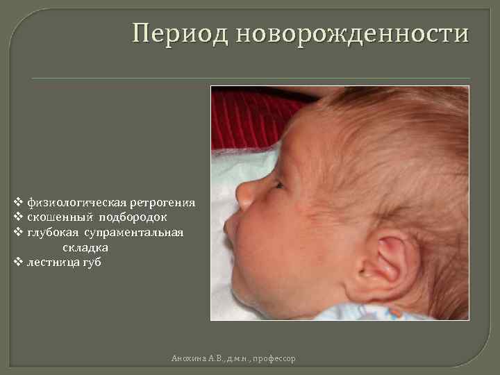 Период новорожденности v физиологическая ретрогения v скошенный подбородок v глубокая супраментальная складка v лестница