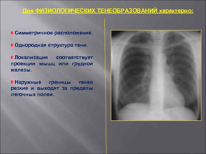 Для ФИЗИОЛОГИЧЕСКИХ ТЕНЕОБРАЗОВАНИЙ характерно: Симметричное расположение. Однородная структура тени. Локализация соответствует проекции мышц или
