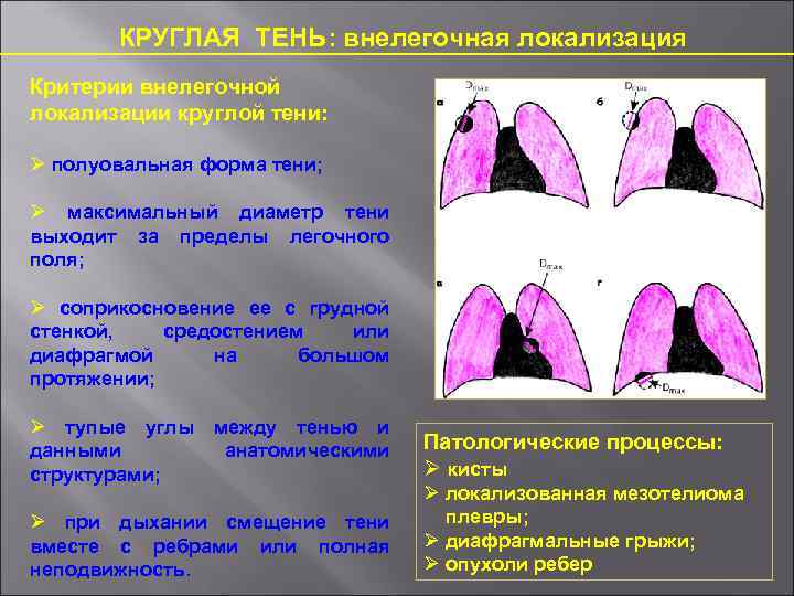 КРУГЛАЯ ТЕНЬ: внелегочная локализация Критерии внелегочной локализации круглой тени: полуовальная форма тени; максимальный диаметр