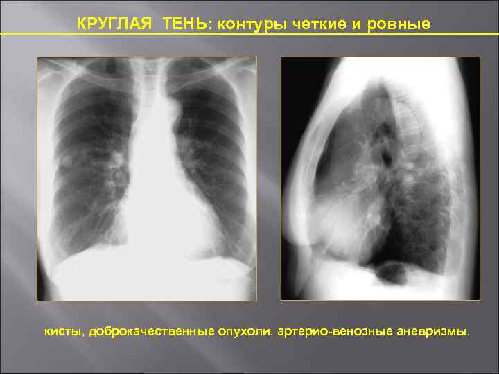 КРУГЛАЯ ТЕНЬ: контуры четкие и ровные кисты, доброкачественные опухоли, артерио-венозные аневризмы. 
