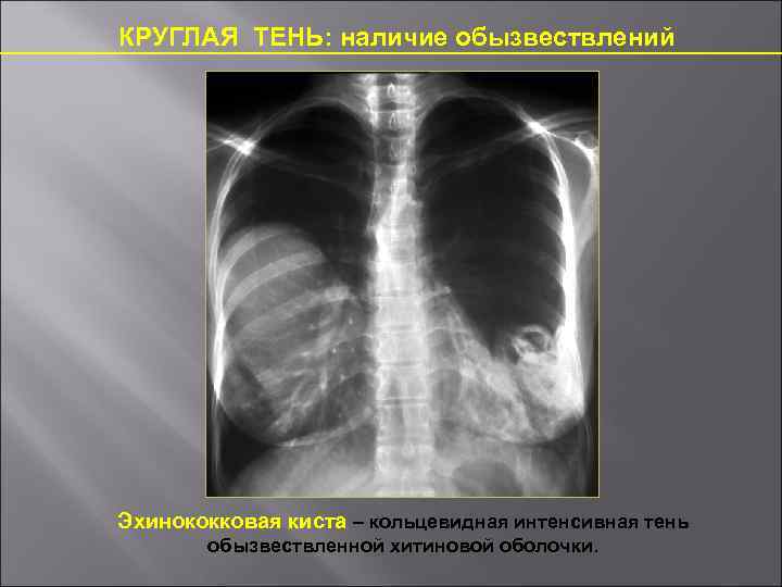 КРУГЛАЯ ТЕНЬ: наличие обызвествлений Эхинококковая киста – кольцевидная интенсивная тень обызвествленной хитиновой оболочки. 