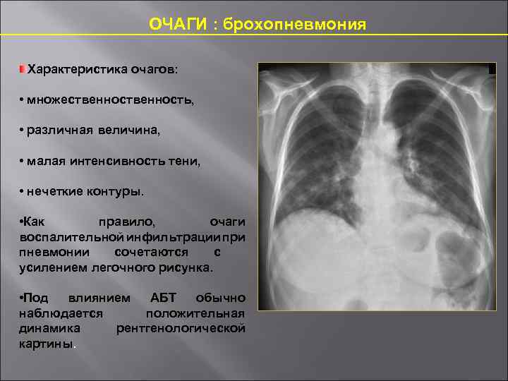 Усиление легочного рисунка при пневмонии