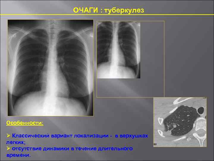 Отсутствие легочного рисунка на рентгене