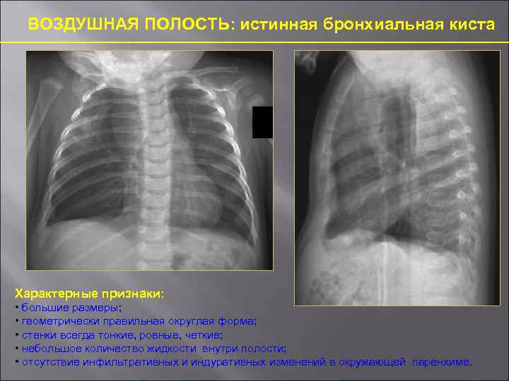 ВОЗДУШНАЯ ПОЛОСТЬ: истинная бронхиальная киста Характерные признаки: • большие размеры; • геометрически правильная округлая