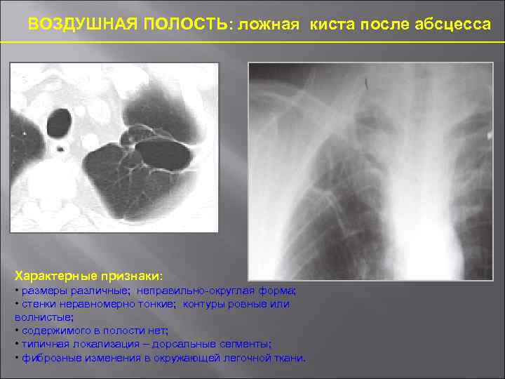 Абсцесс рентгенологические признаки