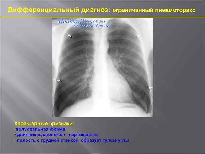 Дифференциальный диагноз: ограниченный пневмоторакс Характерные признаки: • полуовальная форма • длинник расположен вертикально •