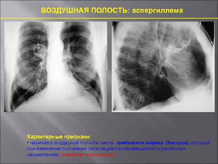 ВОЗДУШНАЯ ПОЛОСТЬ: аспергиллема Характерные признаки: • наличие в воздушной полости кисты грибкового шарика (биссуса),