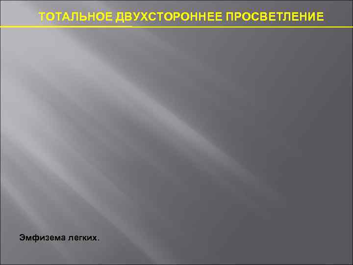 ТОТАЛЬНОЕ ДВУХСТОРОННЕЕ ПРОСВЕТЛЕНИЕ Эмфизема легких. 