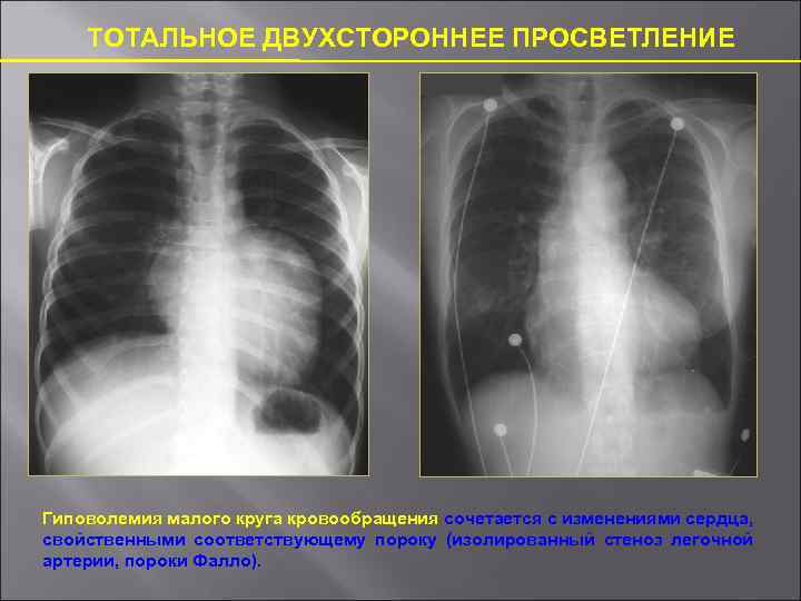 ТОТАЛЬНОЕ ДВУХСТОРОННЕЕ ПРОСВЕТЛЕНИЕ Гиповолемия малого круга кровообращения сочетается с изменениями сердца, свойственными соответствующему пороку
