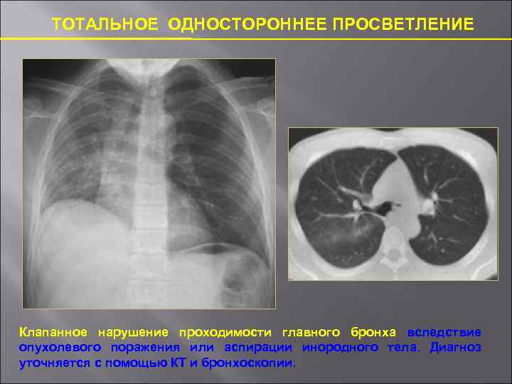 ТОТАЛЬНОЕ ОДНОСТОРОННЕЕ ПРОСВЕТЛЕНИЕ Клапанное нарушение проходимости главного бронха вследствие опухолевого поражения или аспирации инородного