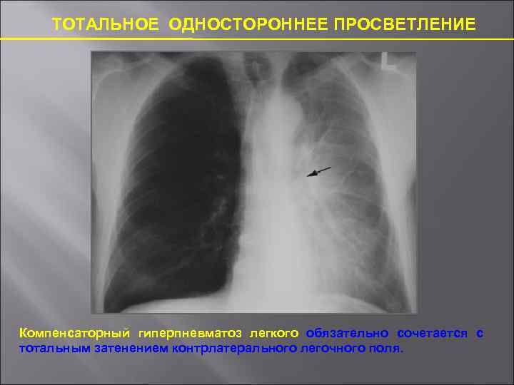 Отсутствие легочного рисунка на рентгене