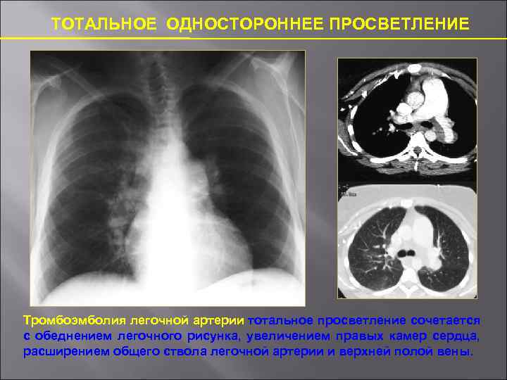 Обеднение легочного рисунка