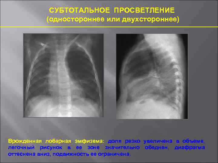 Врожденная лобарная эмфизема клиника рентгенологическая картина принципы лечения